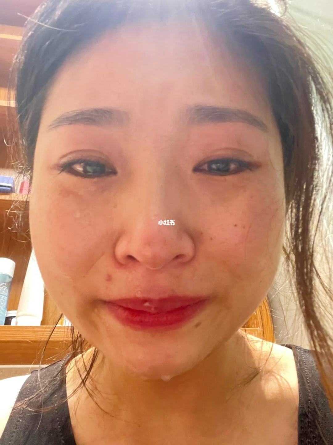 怎么将痣慢慢淡化 脸上有痣怎么去除不留疤
