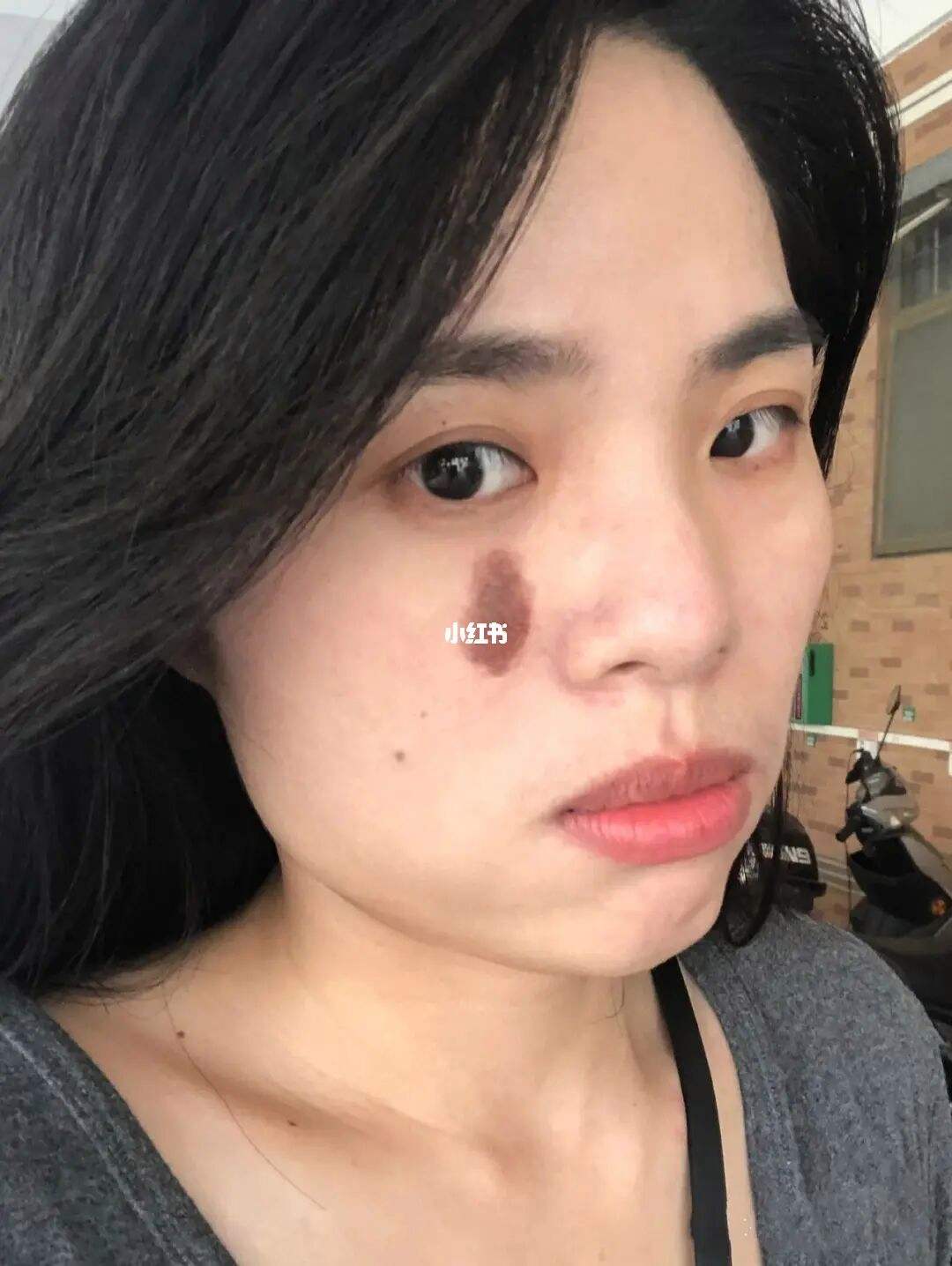 每個人身上都有胎記嗎 是不是每個人生下來都有胎記