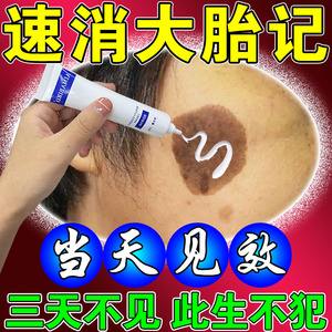 怎麼去除胎記不留痕跡 鐳射去胎記大概需要多少錢呢