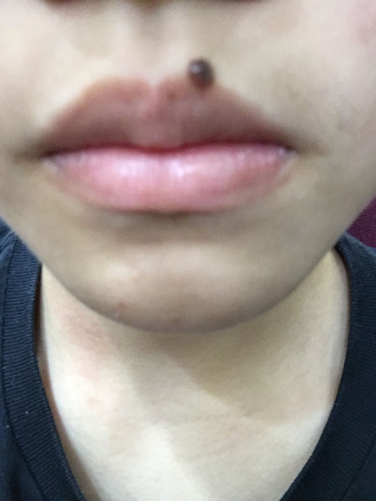 痣能去掉吗 鼻子中间的痣能去掉吗