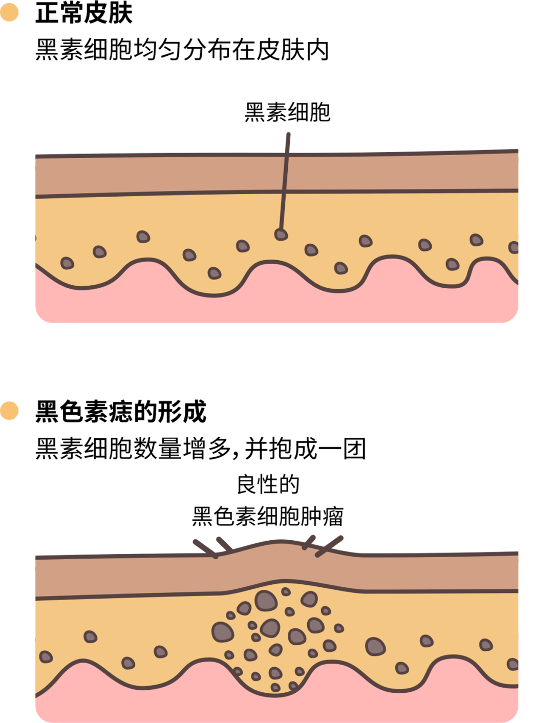 如何区别色素痣以及治疗色素痣 - 知乎